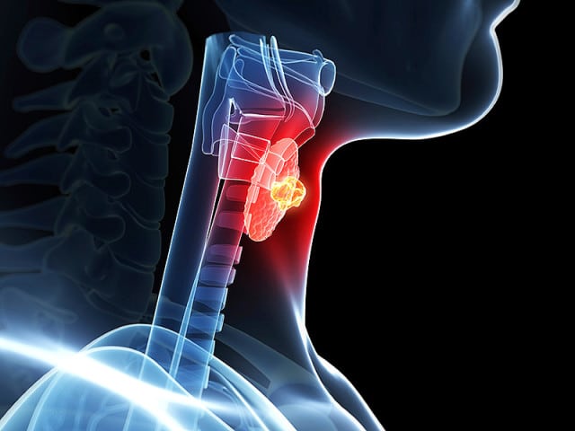 A person's neck is highlighted with a thyroid cancer tumor.